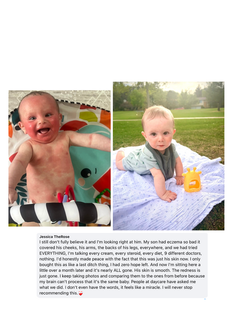 Mella Skin Eczema Cream