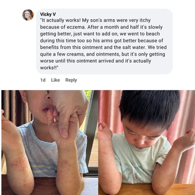 Mella Skin Eczema Cream