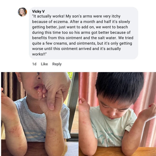 Mella Skin Eczema Cream